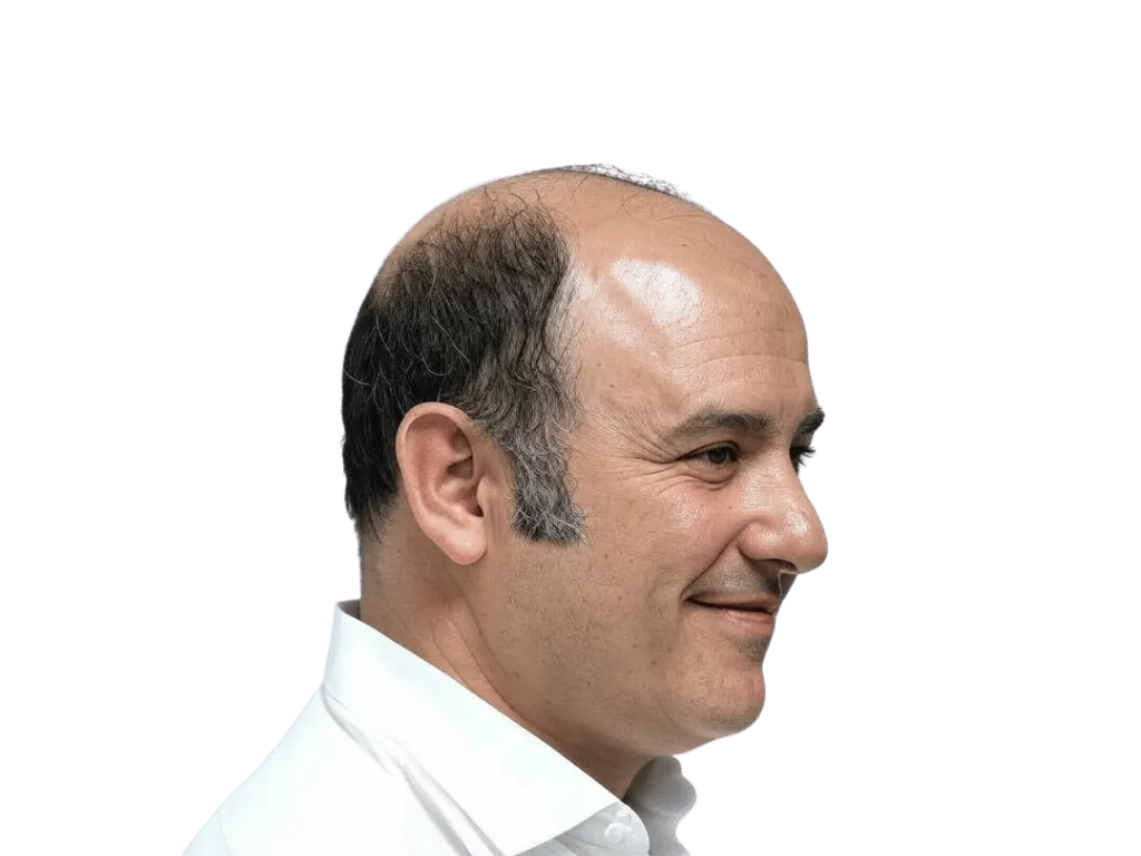 Norwood 7 (Sehr ausgeprägter Haarausfall) - Haarausfall Muster bei Haartransplantation